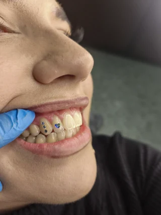 Gemas dentales: corazón y tres cristales
