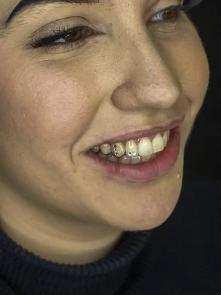 Gemas dentales: composición de cristales