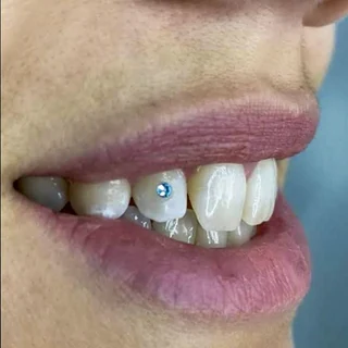 Gema dental azul
